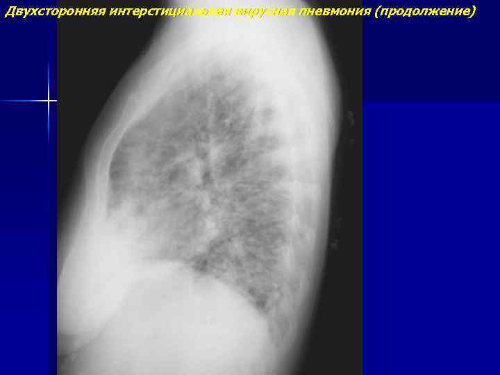 Двухсторонняя интерстициальная вирусная пневмония (продолжение) 