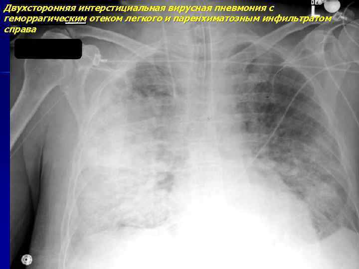 Двухсторонняя интерстициальная вирусная пневмония с геморрагическим отеком легкого и паренхиматозным инфильтратом справа 