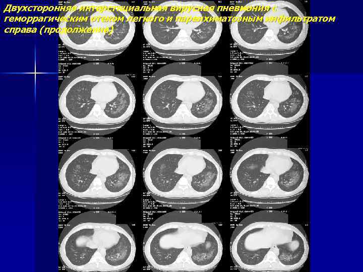 Двухсторонняя интерстициальная вирусная пневмония с геморрагическим отеком легкого и паренхиматозным инфильтратом справа (продолжение) 