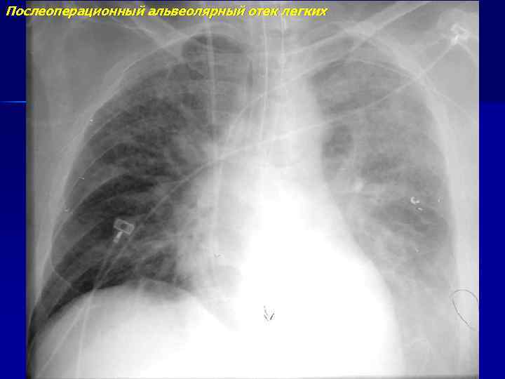 Послеоперационный альвеолярный отек легких 