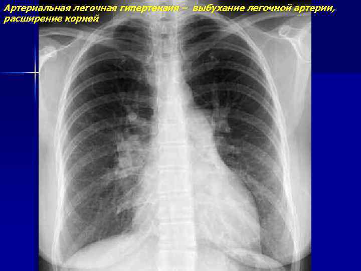 Артериальная легочная гипертензия – выбухание легочной артерии, расширение корней 