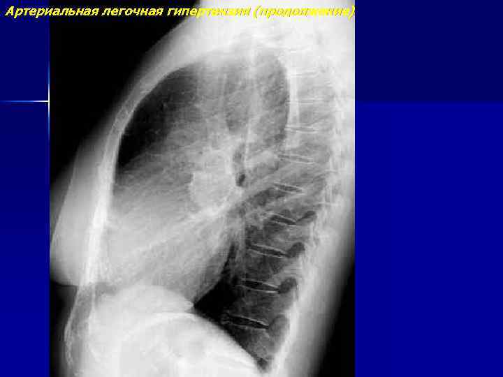 Артериальная легочная гипертензия (продолжение) 