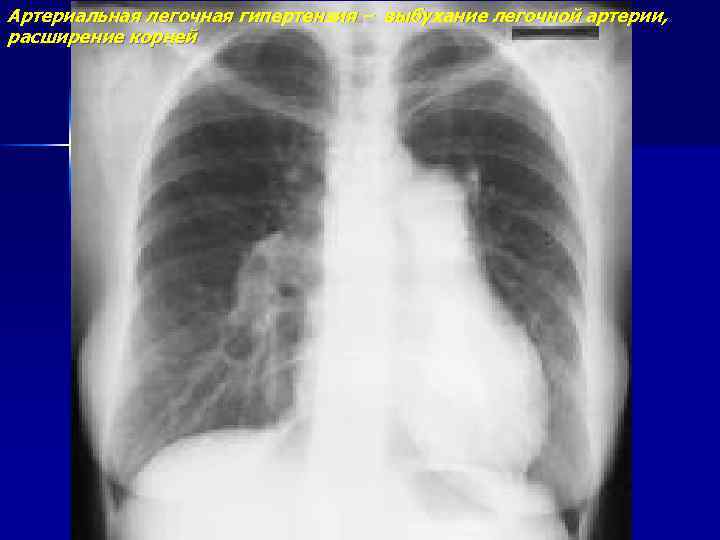 Артериальная легочная гипертензия – выбухание легочной артерии, расширение корней 