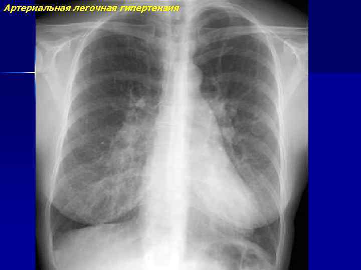 Артериальная легочная гипертензия 