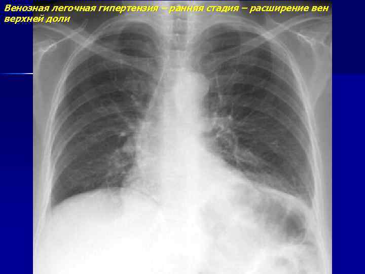 Венозная легочная гипертензия – ранняя стадия – расширение вен верхней доли 