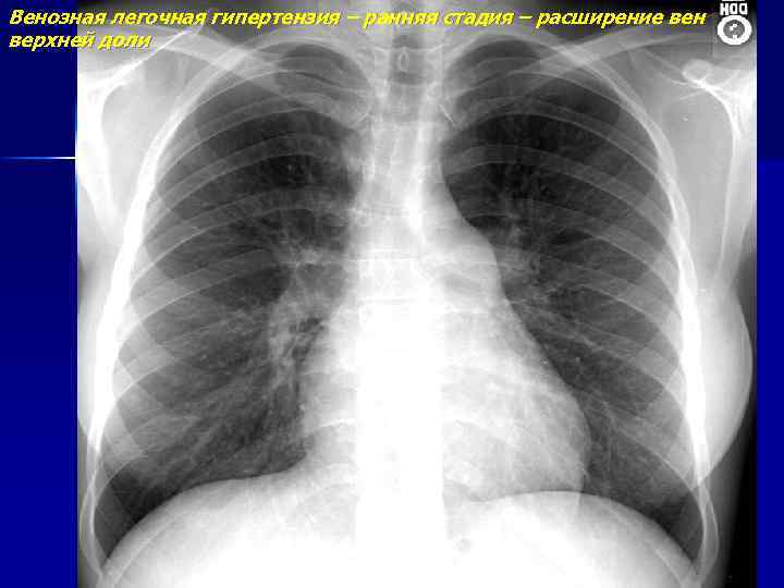 Венозная легочная гипертензия – ранняя стадия – расширение вен верхней доли 