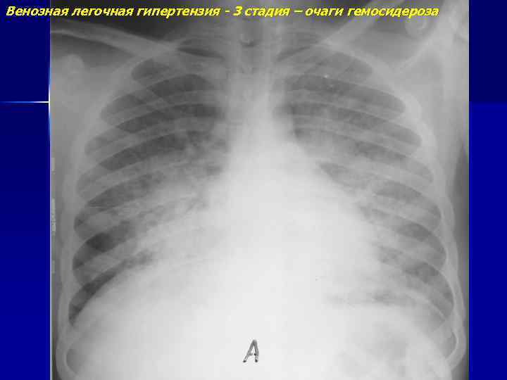 Венозная легочная гипертензия - 3 стадия – очаги гемосидероза 