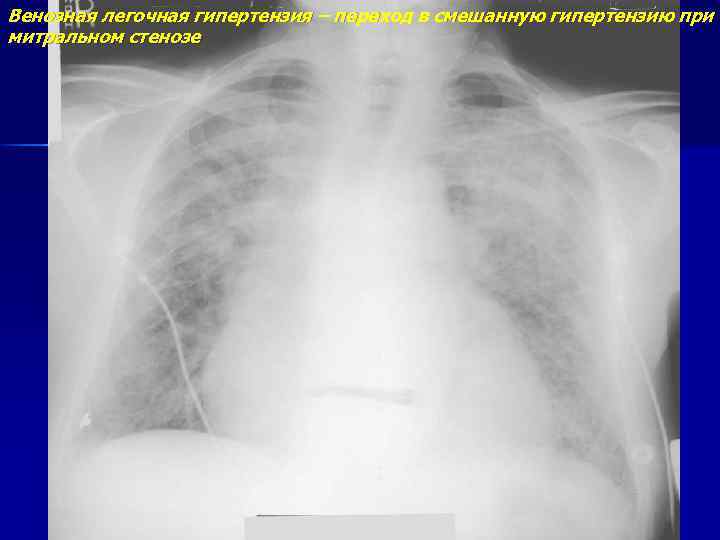 Венозная легочная гипертензия – переход в смешанную гипертензию при митральном стенозе 