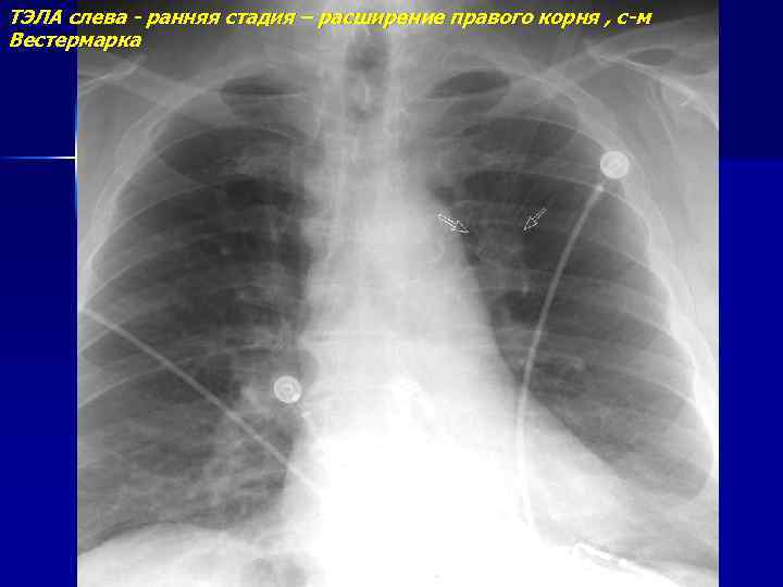 ТЭЛА слева - ранняя стадия – расширение правого корня , с-м Вестермарка 