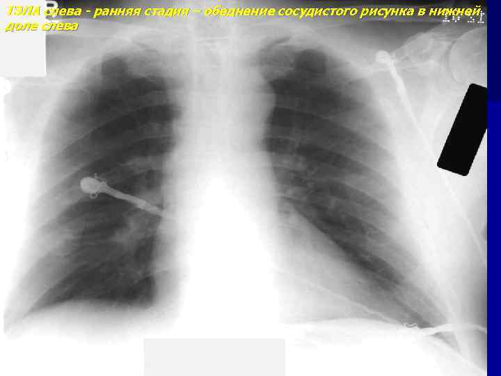 ТЭЛА слева - ранняя стадия – обеднение сосудистого рисунка в нижней доле слева 