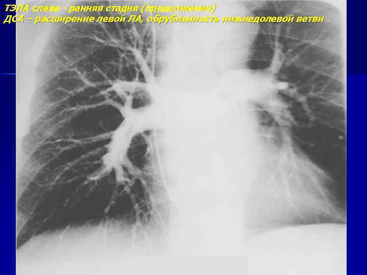 ТЭЛА слева - ранняя стадия (продолжение) ДСА – расширение левой ЛА, обрубленность нижнедолевой ветви