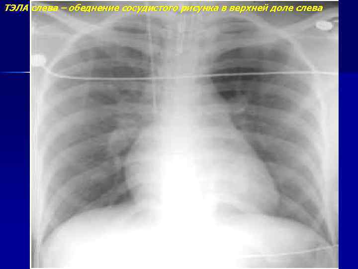 ТЭЛА слева – обеднение сосудистого рисунка в верхней доле слева 