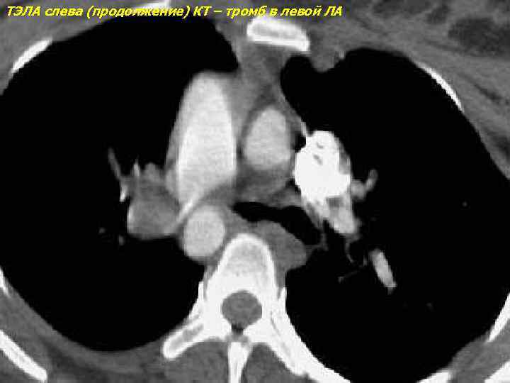 ТЭЛА слева (продолжение) КТ – тромб в левой ЛА 