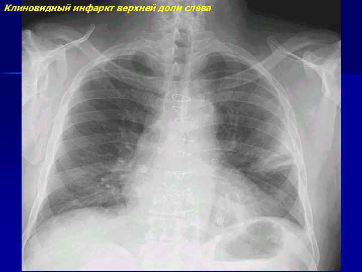 Клиновидный инфаркт верхней доли слева 