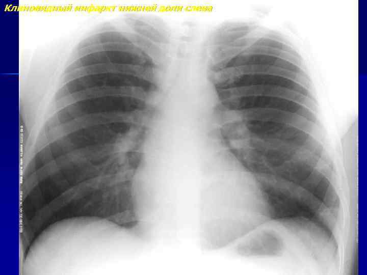 Клиновидный инфаркт нижней доли слева 