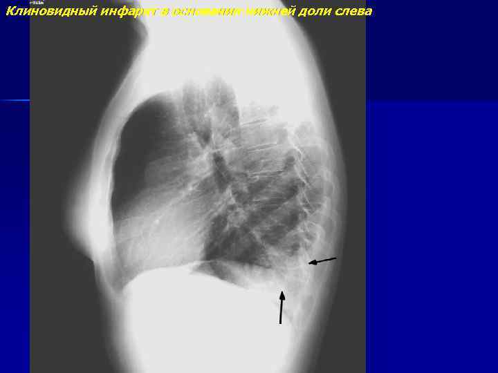 Клиновидный инфаркт в основании нижней доли слева 