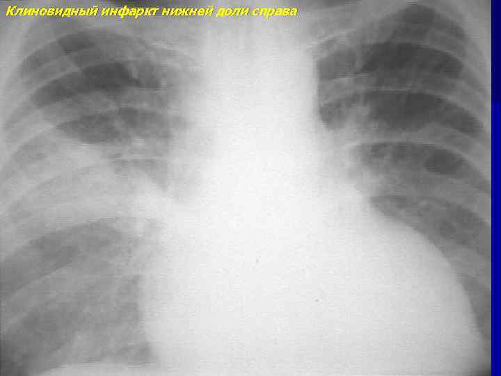 Клиновидный инфаркт нижней доли справа 