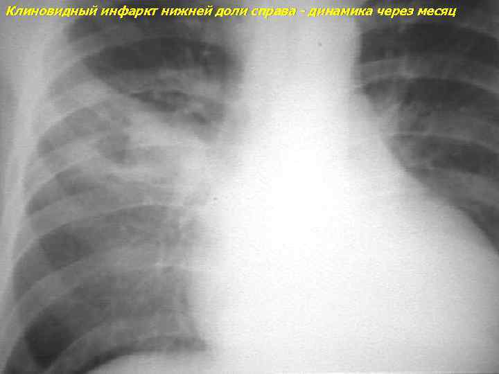 Клиновидный инфаркт нижней доли справа - динамика через месяц 