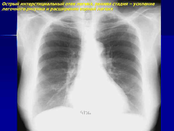 Острый интерстициальный отек легких, ранняя стадия – усиление легочного рисунка и расширение корней легких