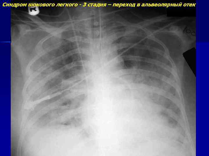 Синдром шокового легкого - 3 стадия – переход в альвеолярный отек 