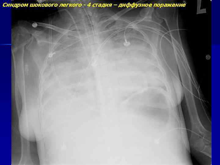 Синдром шокового легкого - 4 стадия – диффузное поражение 