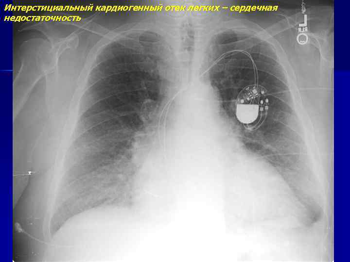 Интерстициальный кардиогенный отек легких – сердечная недостаточность 