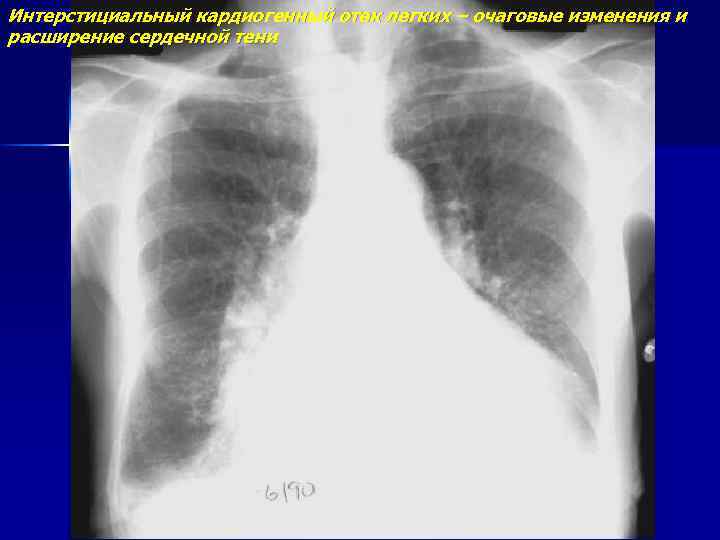 Интерстициальный кардиогенный отек легких – очаговые изменения и расширение сердечной тени 