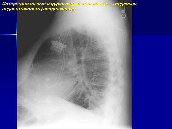 Интерстициальный кардиогенный отек легких – сердечная недостаточность (продолжение) 