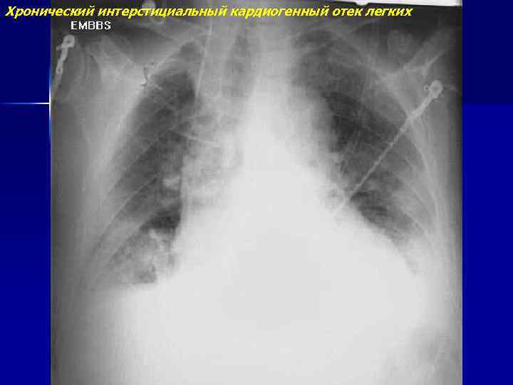 Хронический интерстициальный кардиогенный отек легких 