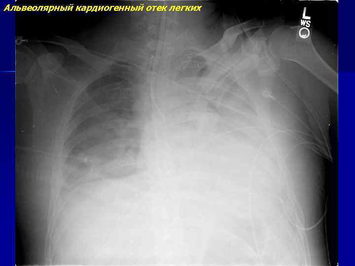 Кардиогенный отек легких фото