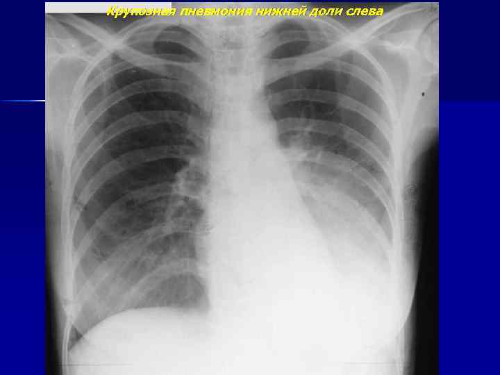 Крупозная пневмония нижней доли слева 
