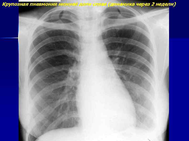 Крупозная пневмония нижней доли слева (динамика через 2 недели) 