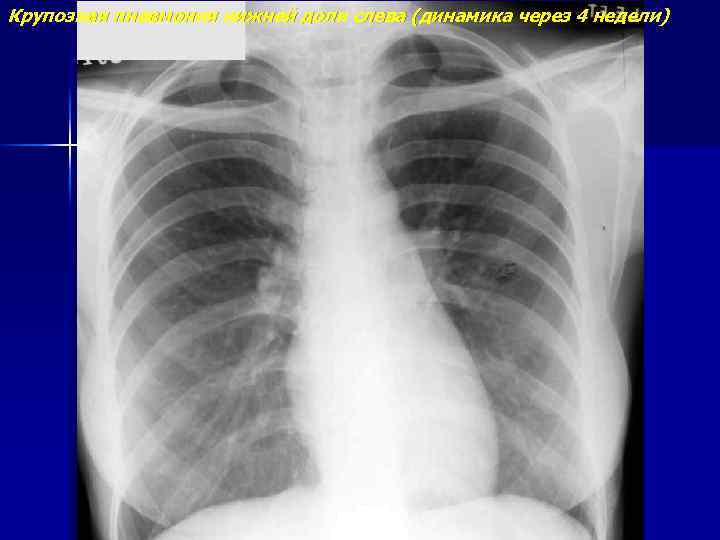 Крупозная пневмония нижней доли слева (динамика через 4 недели) 