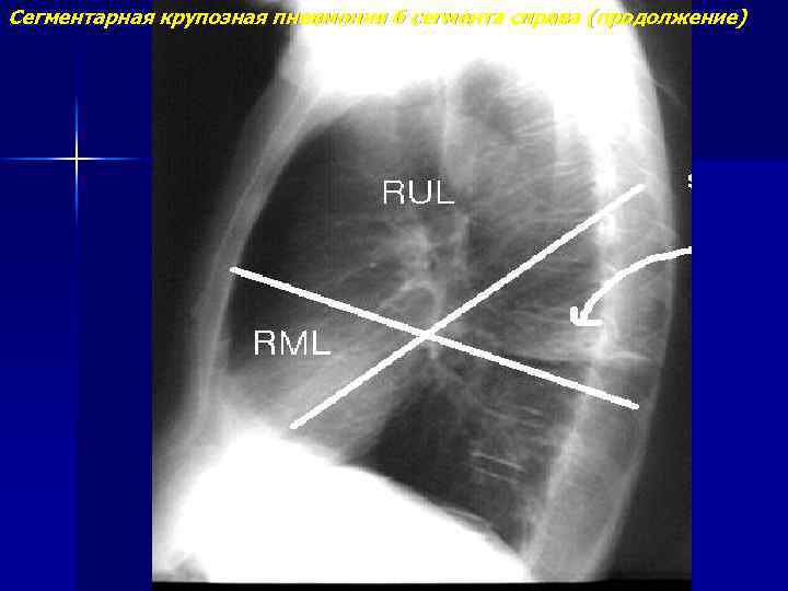 Сегментарная крупозная пневмония 6 сегмента справа (продолжение) 