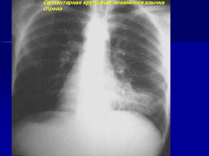 Сегментарная крупозная пневмония язычка справа 