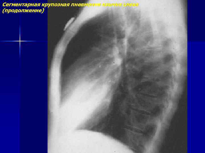 Сегментарная крупозная пневмония язычка слева (продолжение) 
