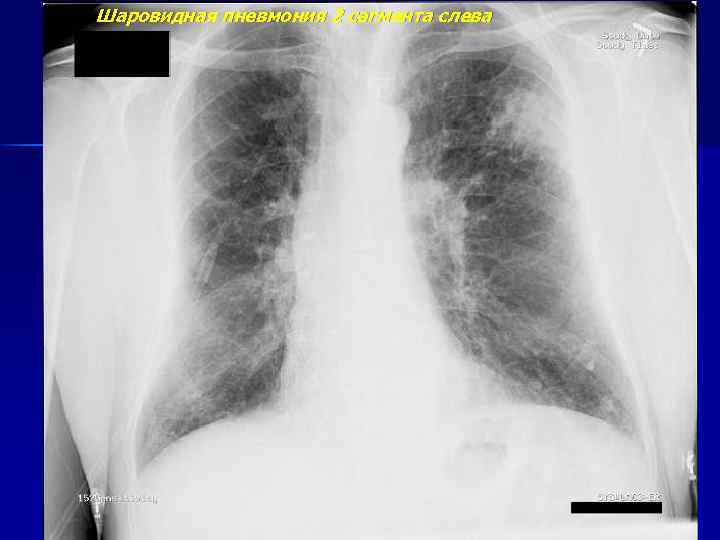 Шаровидная пневмония 2 сегмента слева 