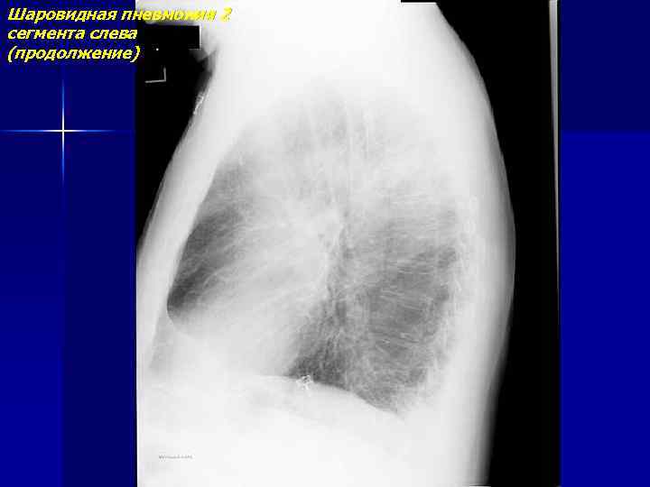 Шаровидная пневмония 2 сегмента слева (продолжение) 