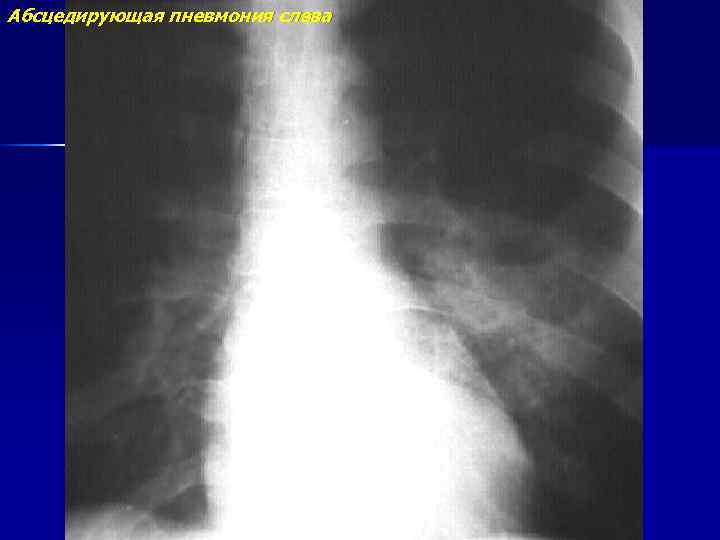 Абсцедирующая пневмония слева 