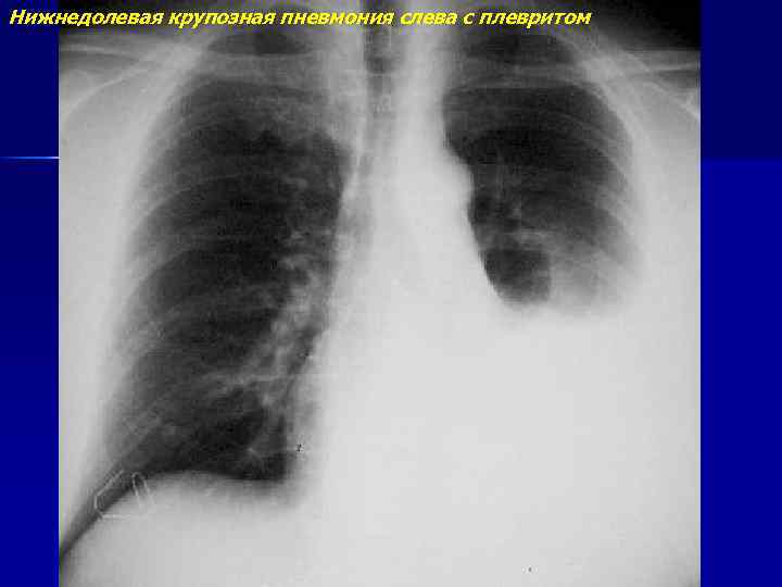 Нижнедолевая крупозная пневмония слева с плевритом 