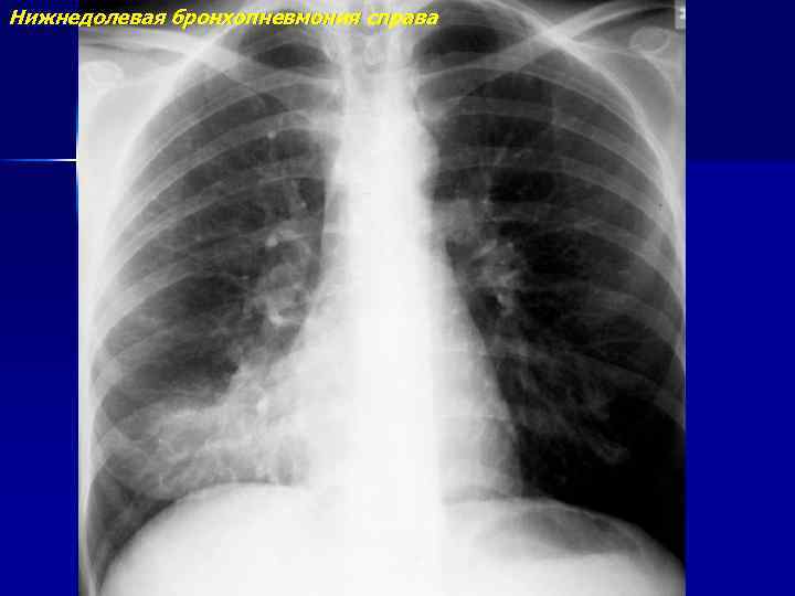 Нижнедолевая бронхопневмония справа 