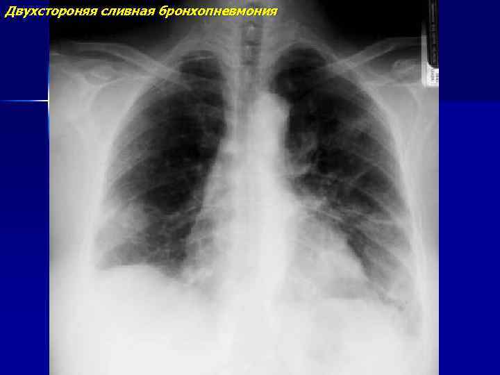 Двухстороняя сливная бронхопневмония 