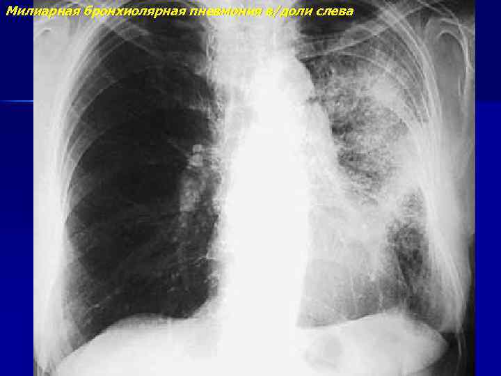 Милиарная бронхиолярная пневмония в/доли слева 
