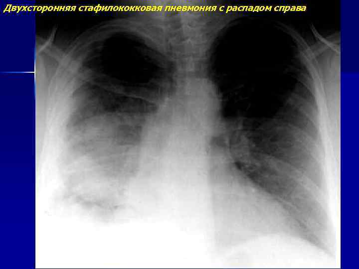 Двухсторонняя стафилококковая пневмония с распадом справа 