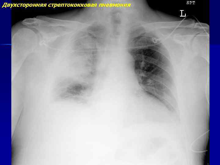 Двухсторонняя стрептококковая пневмония 