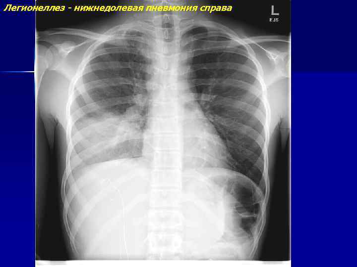 Легионеллез - нижнедолевая пневмония справа 
