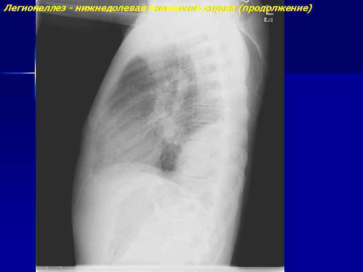 Легионеллез - нижнедолевая пневмония справа (продолжение) 