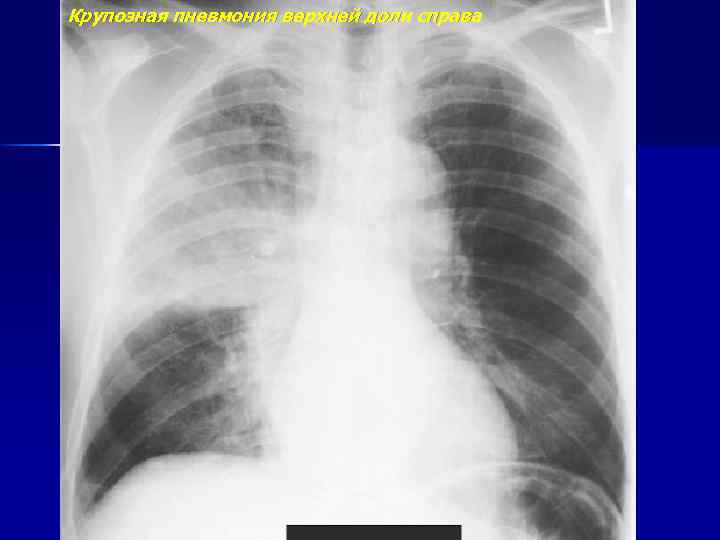 Крупозная пневмония верхней доли справа 