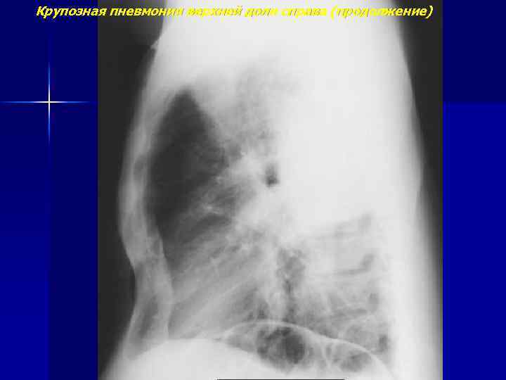 Крупозная пневмония верхней доли справа (продолжение) 