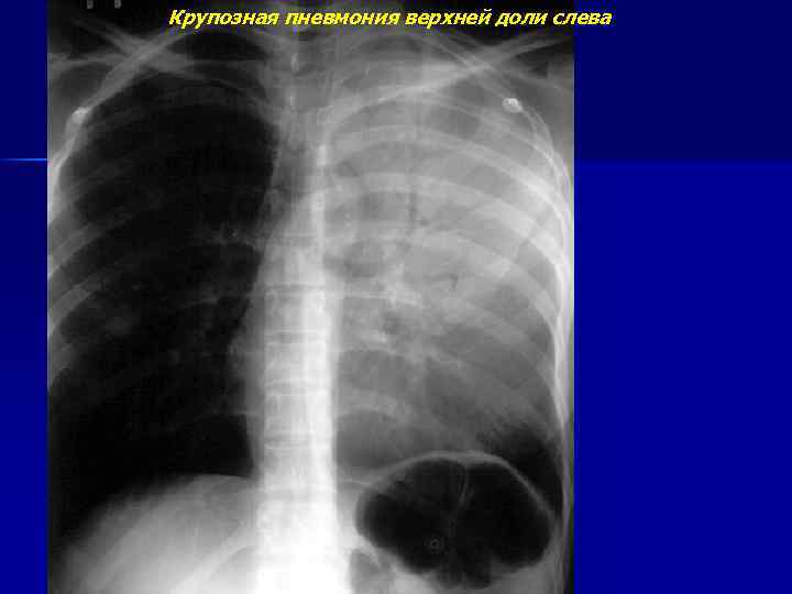 Крупозная пневмония верхней доли слева 